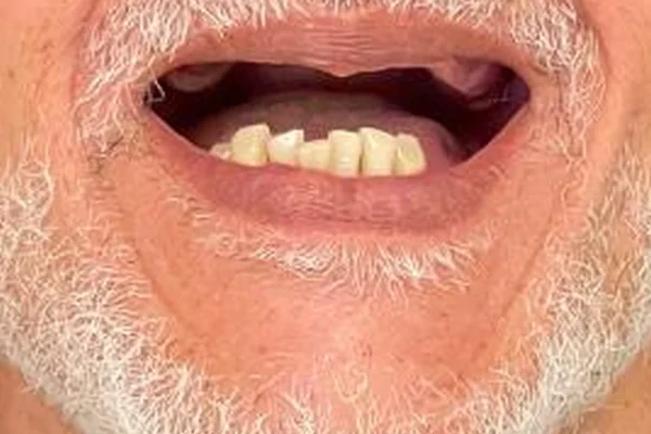 Antes: Sorriso do paciente antes e depois da reabilitação da arcada superior
