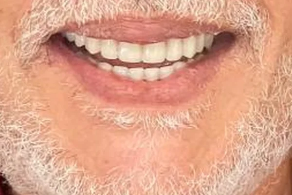 Depois: Sorriso do paciente antes e depois da reabilitação da arcada superior