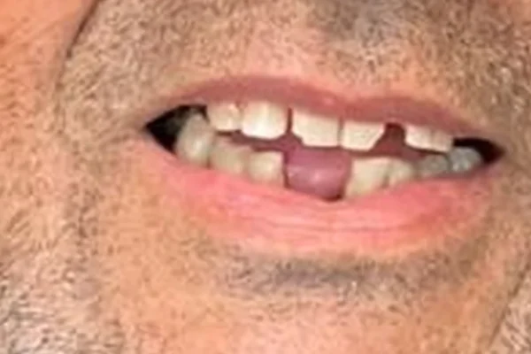 Antes: Sorriso do paciente antes e depois da reposição dos dentes anteriores