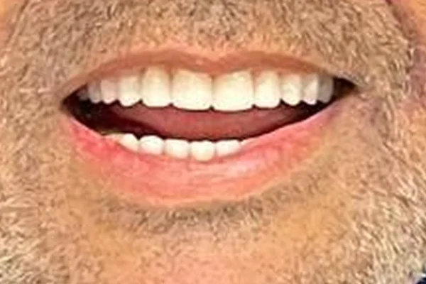 Depois: Sorriso do paciente antes e depois da reposição dos dentes anteriores
