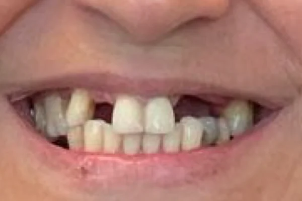 Antes: Sorriso do paciente antes e depois da reabilitação com implantes