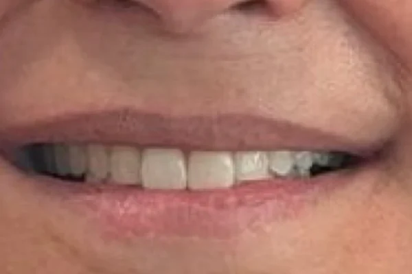 Depois: Sorriso do paciente antes e depois da reabilitação com implantes