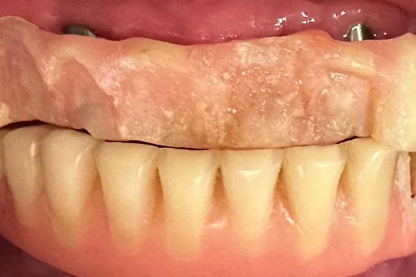 Antes: Registro intraoral antes e depois da instalação do protocolo