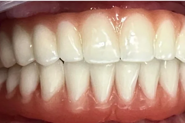 Depois: Registro intraoral antes e depois da instalação do protocolo