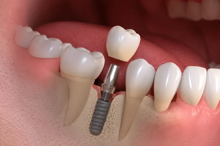 Ilustração clínica de um implante dentário unitário instalado no osso
