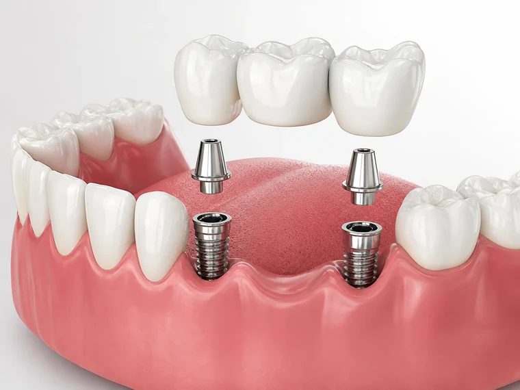 Ilustração clínica de uma prótese fixa apoiada sobre implantes