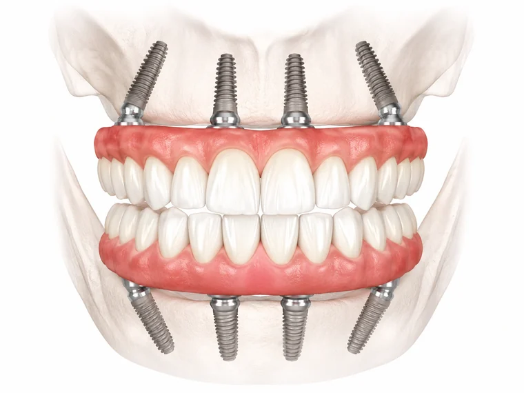 Ilustração clínica de uma reabilitação total de arcada sobre implantes